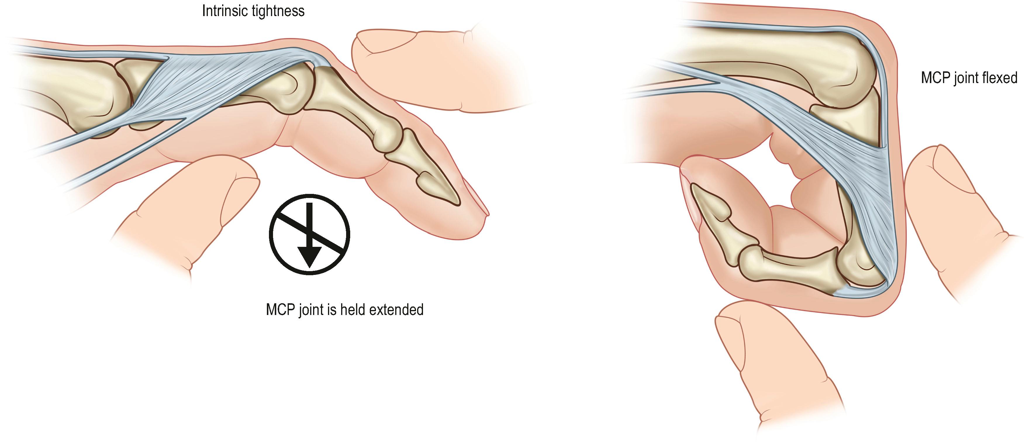 Figure 30.3, Bunnell test for intrinsic tightness. The MCP joint is passively extended and the PIP joint is passively flexed. The MCP joint is then passively flexed and the PIP joint is again passively flexed. If the PIP flexion is improved with MCP joint flexion, this is an indication of intrinsic tightness.