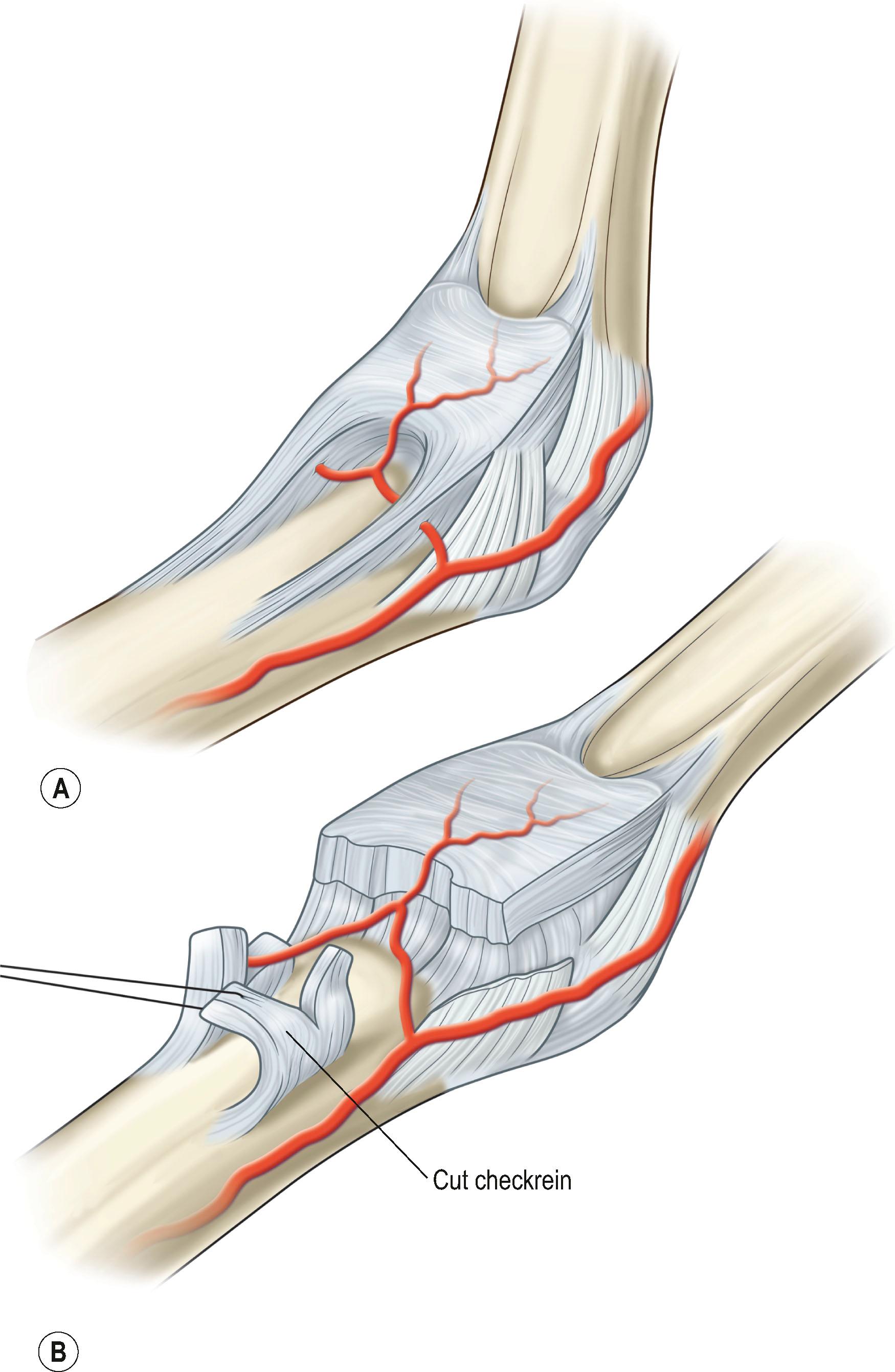 Figure 30.4, (A,B) Checkrein ligaments. The checkrein ligaments are pathologic structures that form at the PIP joint between the lateral proximal volar plate and the proximal phalanx after injury.