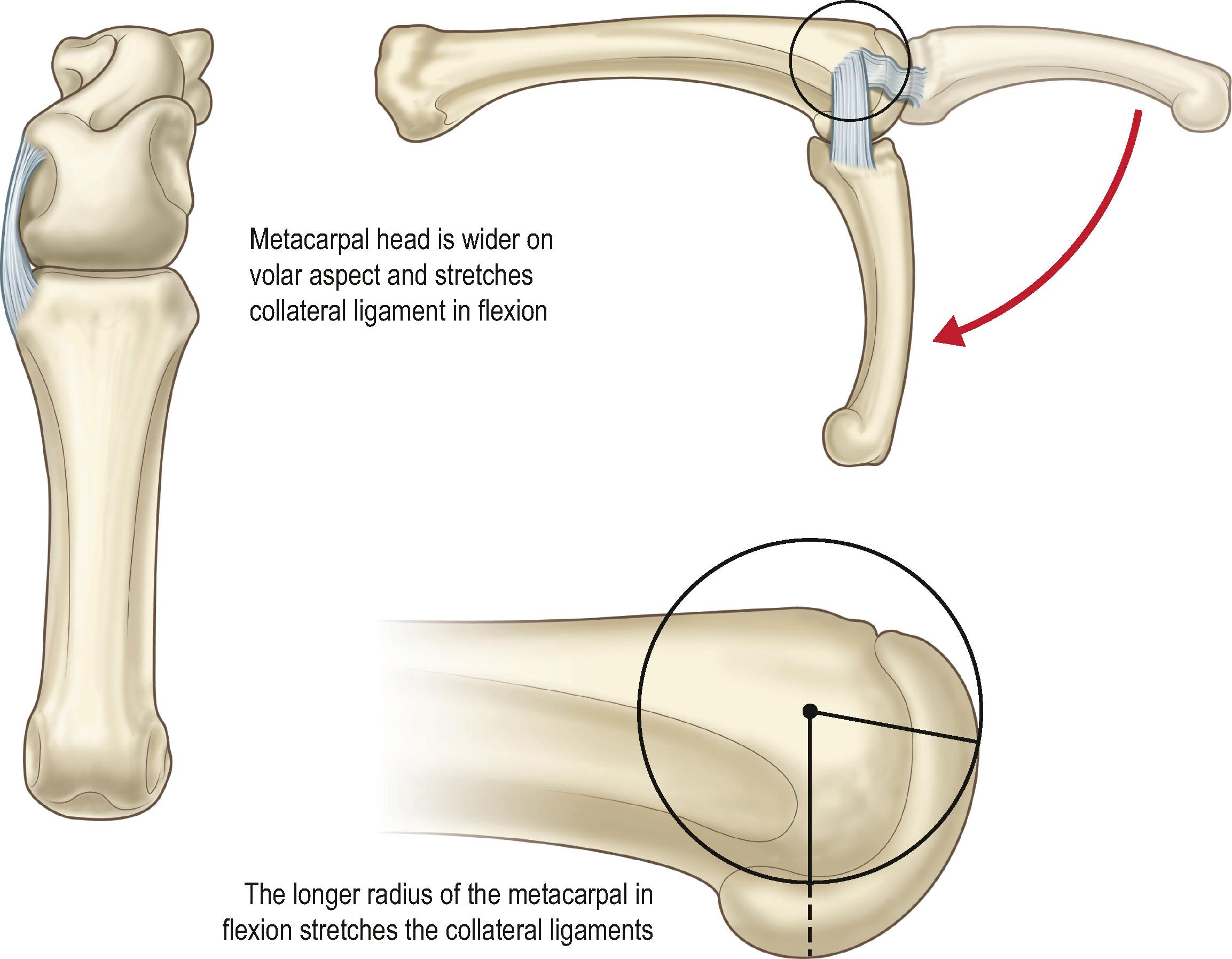 Figure 30.5, Metacarpal head morphology. The metacarpal head is not spherical; it has a cam morphology due to a volar flare. The radius of the metacarpal head is longer in flexion than in extension. Therefore, when the MCP joint is flexed, the collateral ligaments are at their maximal length. This makes flexion the protected position for the MCP joint in order that the collateral ligaments do not contract in their shortened position, with MCP extension.