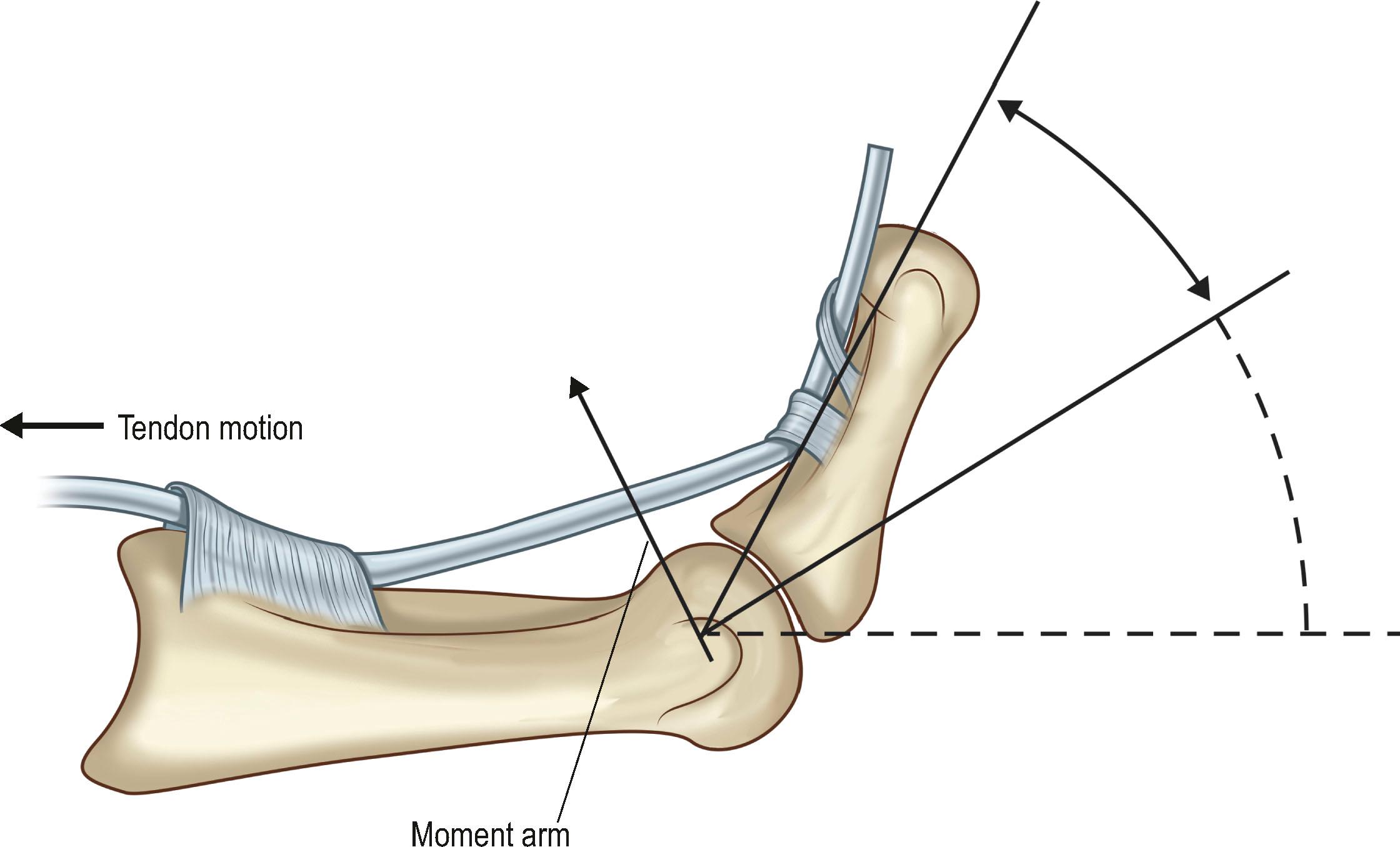 Figure 30.6, Tendon bowstringing. When a pulley in the finger is injured, the flexor tendon will pull away from the bone as the proximal muscle contracts. This increases the mean moment arm and results in wasted linear tendon excursion away from the bone. The increased force that is required to flex the finger due to the inefficiency in flexion eventually results in flexion contracture.