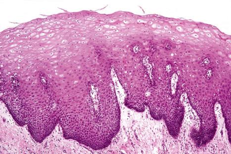 Fig. 1.14, Mucosal aspect of lip: the cytoplasm of the keratinocytes is often rich in glycogen.