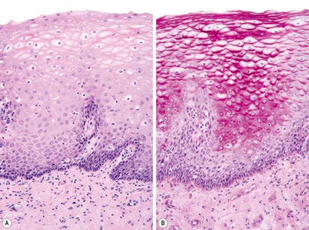 Fig. 1.16, ( A , B ) Vulval vestibule: at this site the stratum corneum is absent and there is no granular cell layer. The suprabasal keratinocytes have clear cytoplasm due to abundant glycogen and revealed by the periodic acid-Schiff reaction.