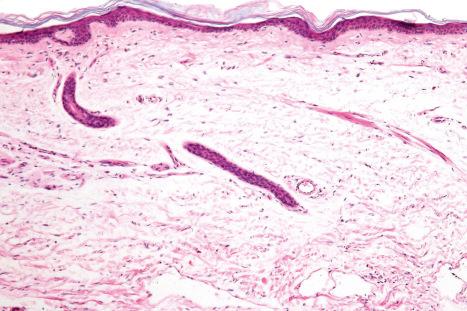 Fig. 1.17, Variation of skin: sample of skin from the forearm of a 92-year-old female. Note the epidermal thinning and dermal atrophy.