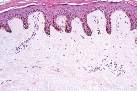 Fig. 1.20, Variation of normal skin: in dark-skinned races, the presence of intense basal cell melanin pigmentation is a normal histologic finding.