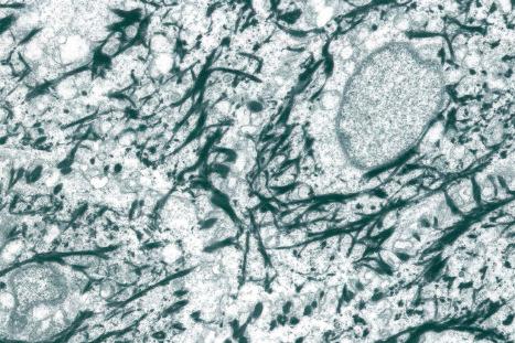 Fig. 1.23, Mid-prickle cell layer of normal epidermis: the abundant keratin filaments (tonofibrils) form a distinct interlacing lattice within the cytoplasm of keratinocytes.