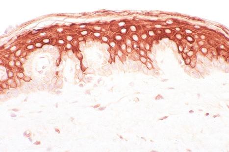 Fig. 1.24, Normal skin: suprabasal keratinocytes preferentially express keratins 1 and 10 as shown in this picture. Anti-Keratin1 antibody courtesy of I.M. Leigh, MD, Royal London Hospital Trust, London, UK.