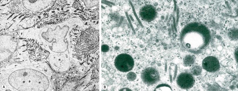 Fig. 1.34, ( A , B ) Langerhans cell: ( A ) note the characteristic lobulated nucleus. Dendritic processes are evident, ( B ) typical rod forms with the characteristic trilaminar structure.