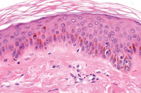 Fig. 1.39, Melanin pigment: actinically damaged skin. Note that the melanin pigment is located in a ‘cap’ overlying the keratinocyte nuclei.