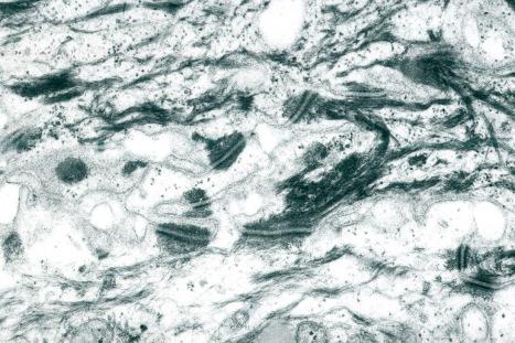 Fig. 1.45, Mid-prickle cell layer of normal epidermis: there are complex interdigitations between adjacent cell membranes with numerous desmosomal junctions.