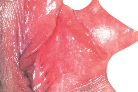 Fig. 1.51, Sebaceous glands: on the inner aspect of the labia these appear as tiny yellow papules (Fordyce spots).