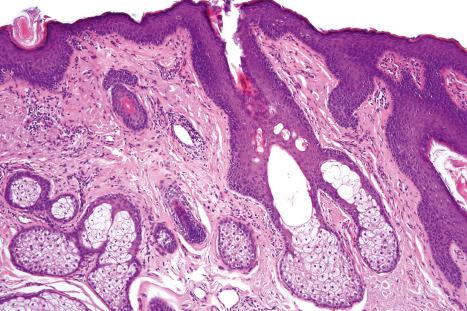 Fig. 1.52, Normal vulva: sebaceous glands are conspicuous, but arise independently of a hair follicle and open directly onto the surface epithelium.