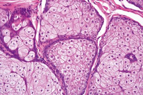 Fig. 1.55, Sebaceous lobule: germinative cells are basophilic and flattened. With maturation the cells acquire their characteristic ‘bubbly’ cytoplasm.