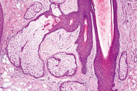 Fig. 1.56, Sebaceous duct: this is lined by keratinizing stratified squamous epithelium; it is continuous with the external root sheath.