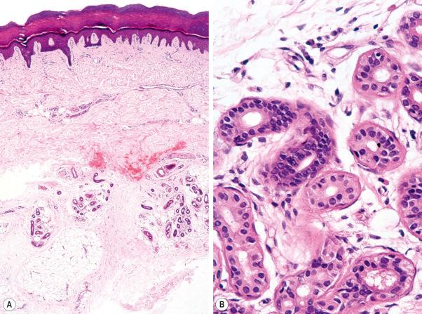 Fig. 1.59, Eccrine gland: ( A ) palmar skin showing numerous eccrine glands located in the deep reticular dermis and subcutaneous fat, ( B ) the secretory unit is in the lower field. Sections through the coiled duct are evident in the upper field. The epithelium of the duct is more darkly stained than that of the glandular component.