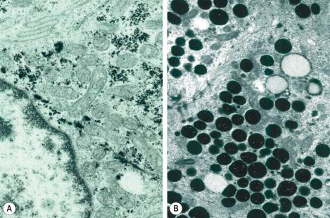 Fig. 1.65, Eccrine gland: ( left ) high-power view of clear cell showing conspicuous mitochondria and numerous electron-dense glycogen granules, ( right ) high-power view of secretory granules in a dark cell.