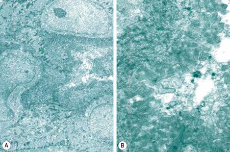 Fig. 1.66, Eccrine gland: ( A ) lumen of the eccrine dermal duct lined by conspicuous microvilli, ( B ) high-power view of eccrine dermal duct showing microvilli and circumferentially orientated tonofilaments.