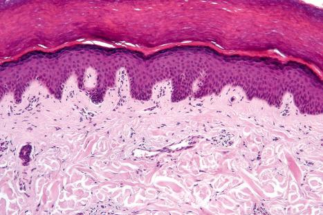 Fig. 1.7, Skin from the sole of the foot: this is typified by a thickened stratum corneum and prominent epidermal ridge pattern. The dermis is relatively dense at this site. Similar features are seen on the palms and ventral aspects of the fingers and toes.