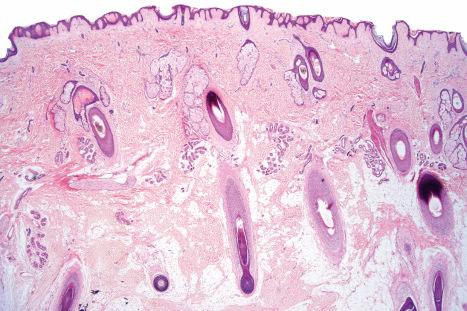 Fig. 1.8, Skin from the scalp: there are numerous terminal hair follicles with many of the bulbs in the subcutaneous fat.