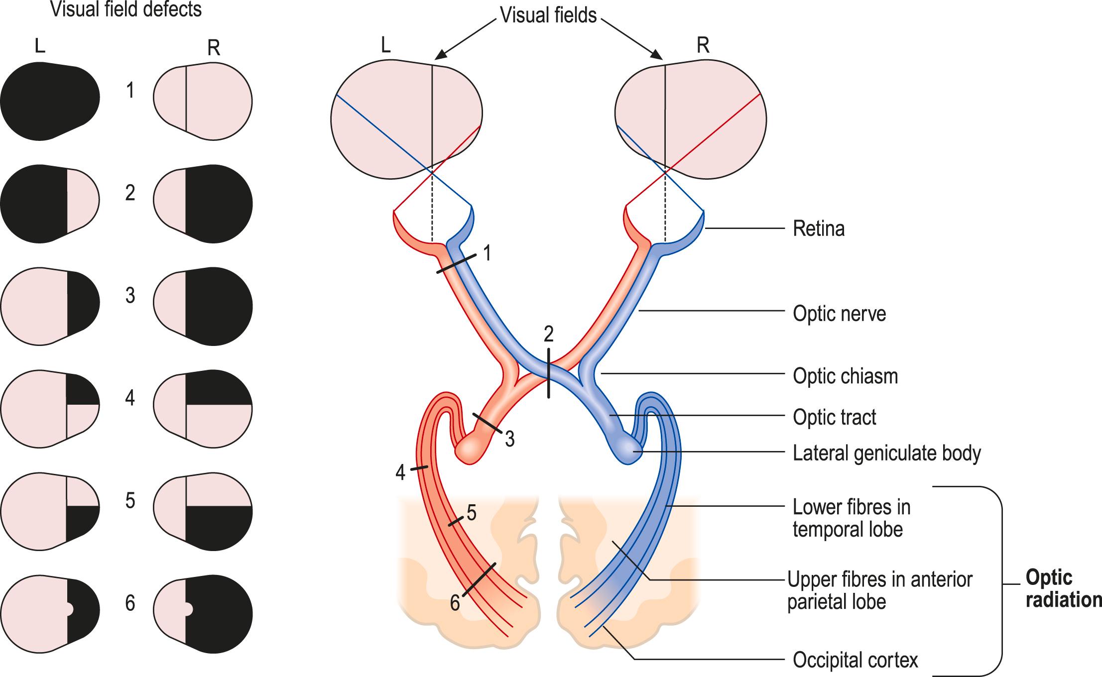 Fig. 8.5, Visual field defects.