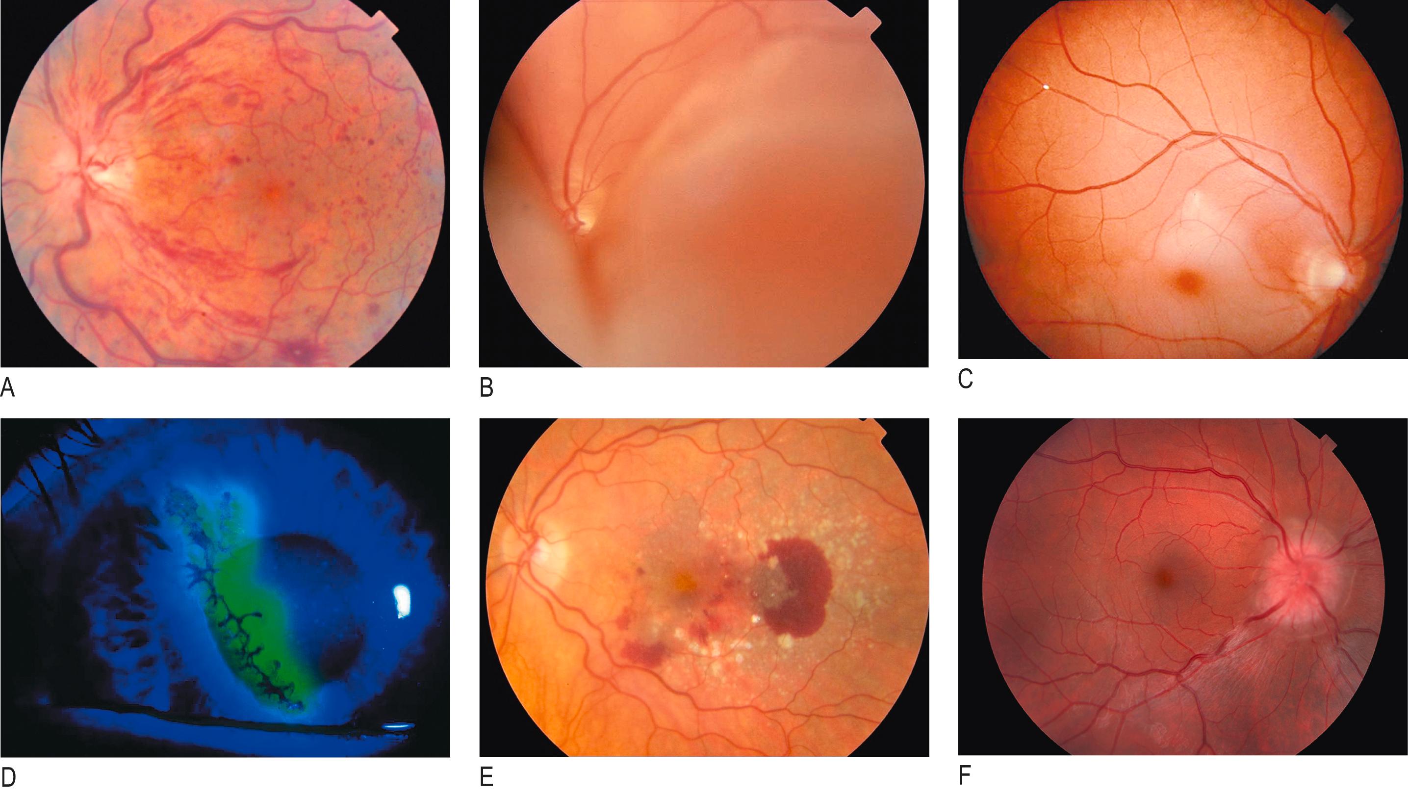 Fig. 8.7, Common causes of an acute change in vision.