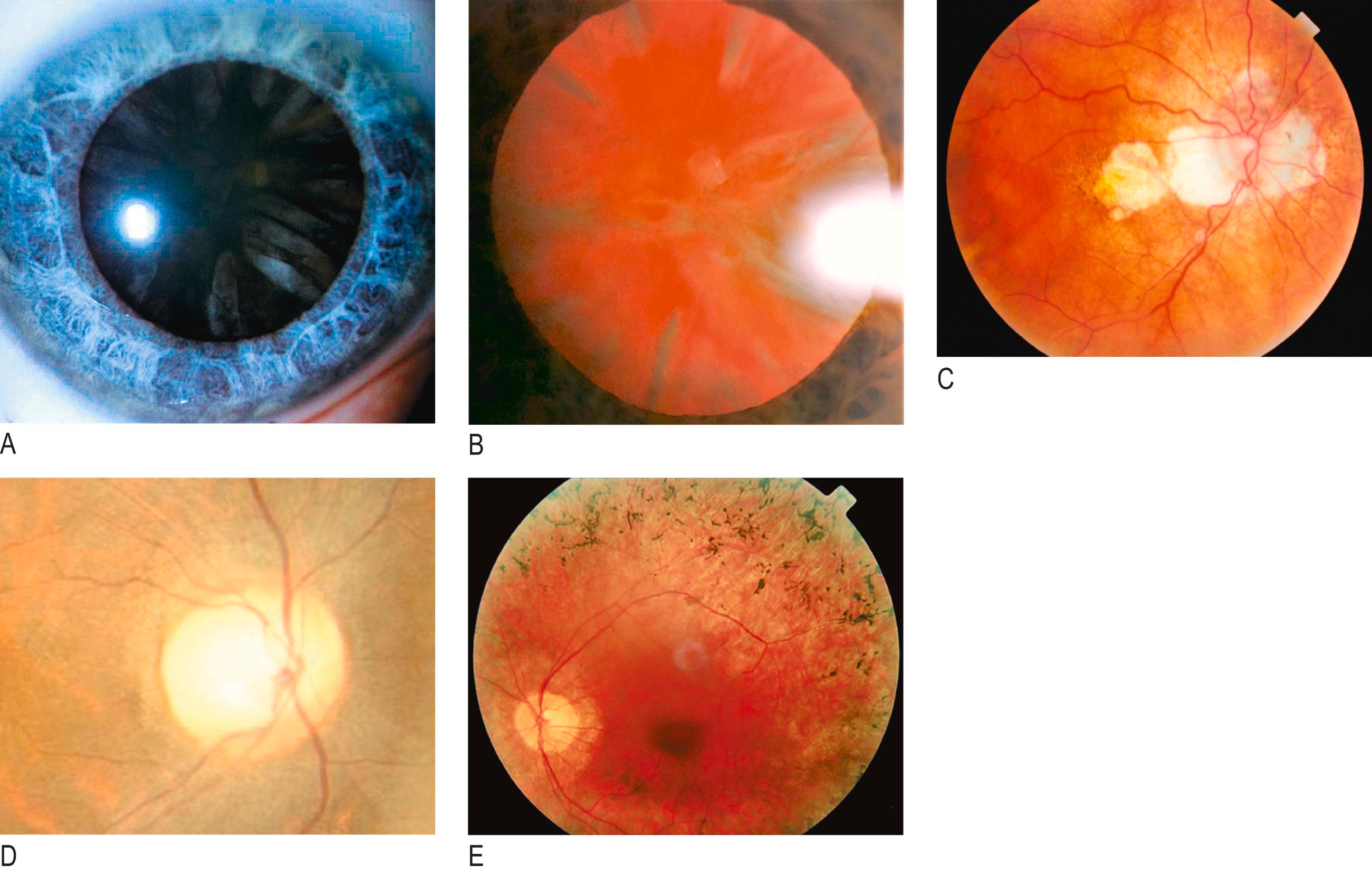 Fig. 8.8, Common causes of a gradual loss of vision.