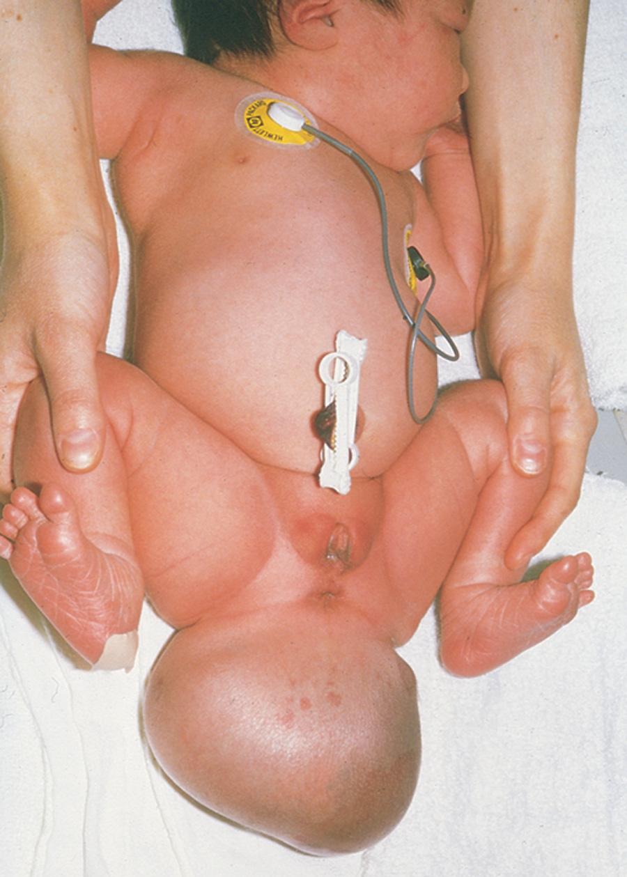 Fig. 4.7, Female infant with a large sacrococcygeal teratoma that developed from remnants of the primitive streak. The tumor, a neoplasm made up of several different types of tissue, was surgically removed.