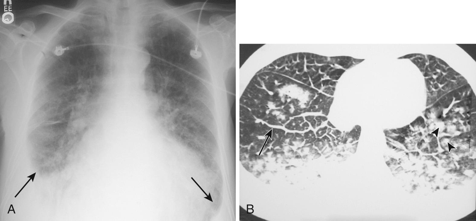 Figure 9.1, Effusion from congestive heart failure. A, A frontal chest radiograph in a patient with pulmonary edema shows cardiomegaly, bilateral pleural effusions (arrows), and central interstitial thickening, including Kerley's A lines. Note that the right effusion is slightly larger than the left effusion. B, High-resolution computed tomography scan in a patient with pulmonary edema shows interstitial edema with bilateral, basilar, centrilobular ground-glass opacity nodules (arrowheads) and smooth interlobular septal thickening (arrow). Bilateral pleural effusions are also present.