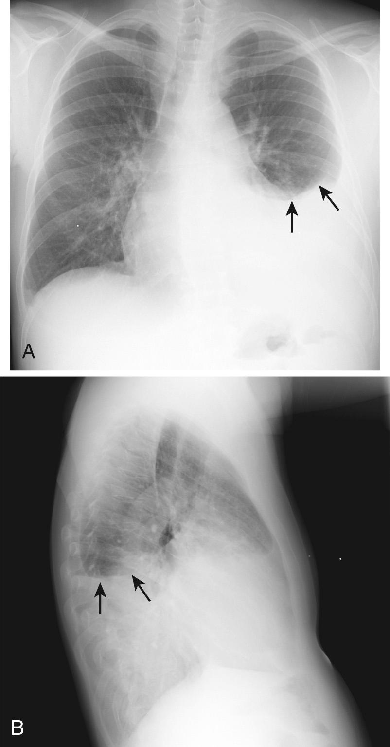 Figure 9.3, Left-sided pleural effusion seen on A, posteroanterior and B, lateral radiographs. The meniscus can be visualized on both views ( arrows ).