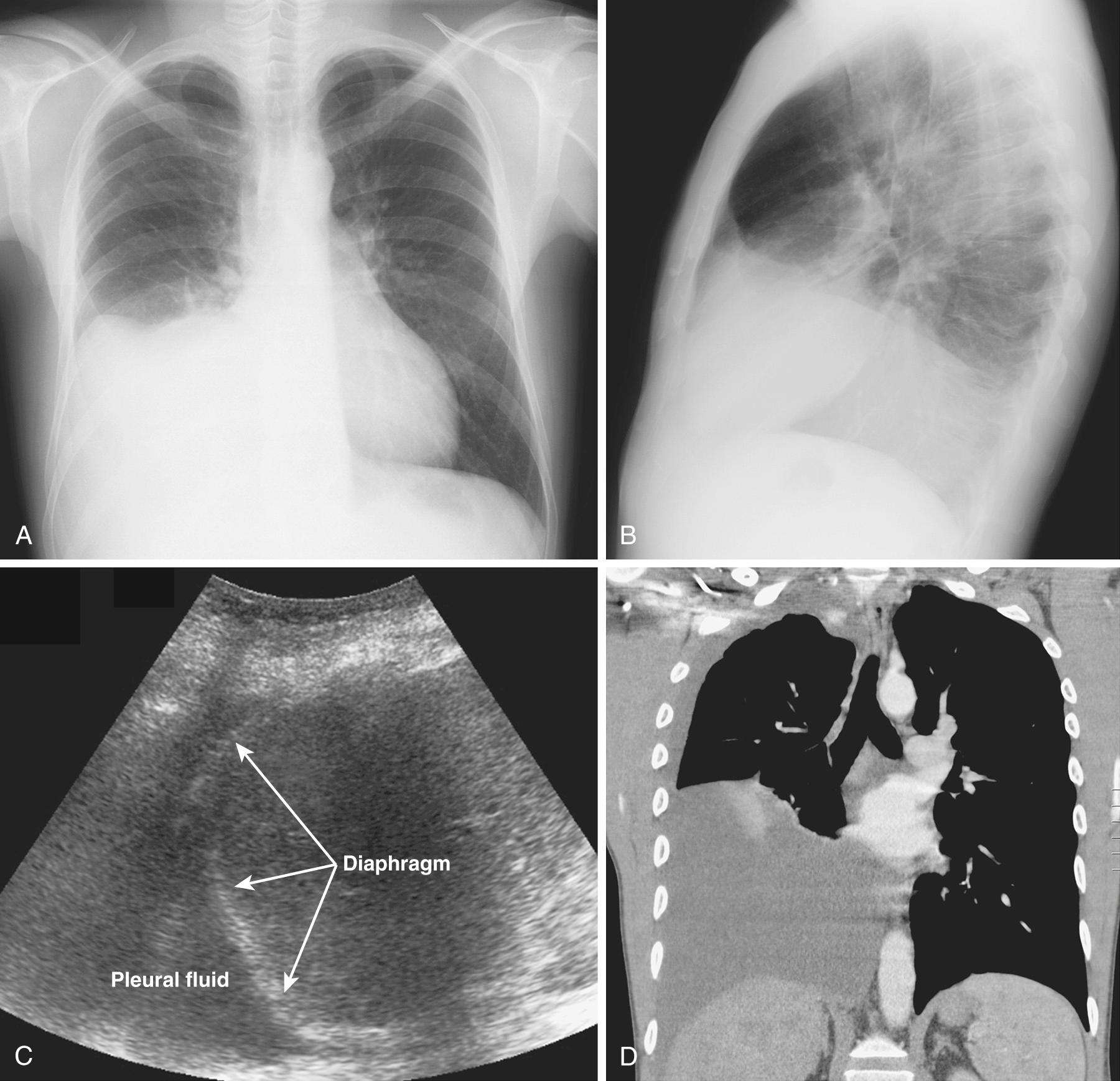 Figure 9.4, Right-sided subpulmonic pleural effusion. On erect A, posteroanterior and B, lateral radiographs, the effusion simulates a high hemidiaphragm. It is also seen with C, ultrasound and D, computed tomography.