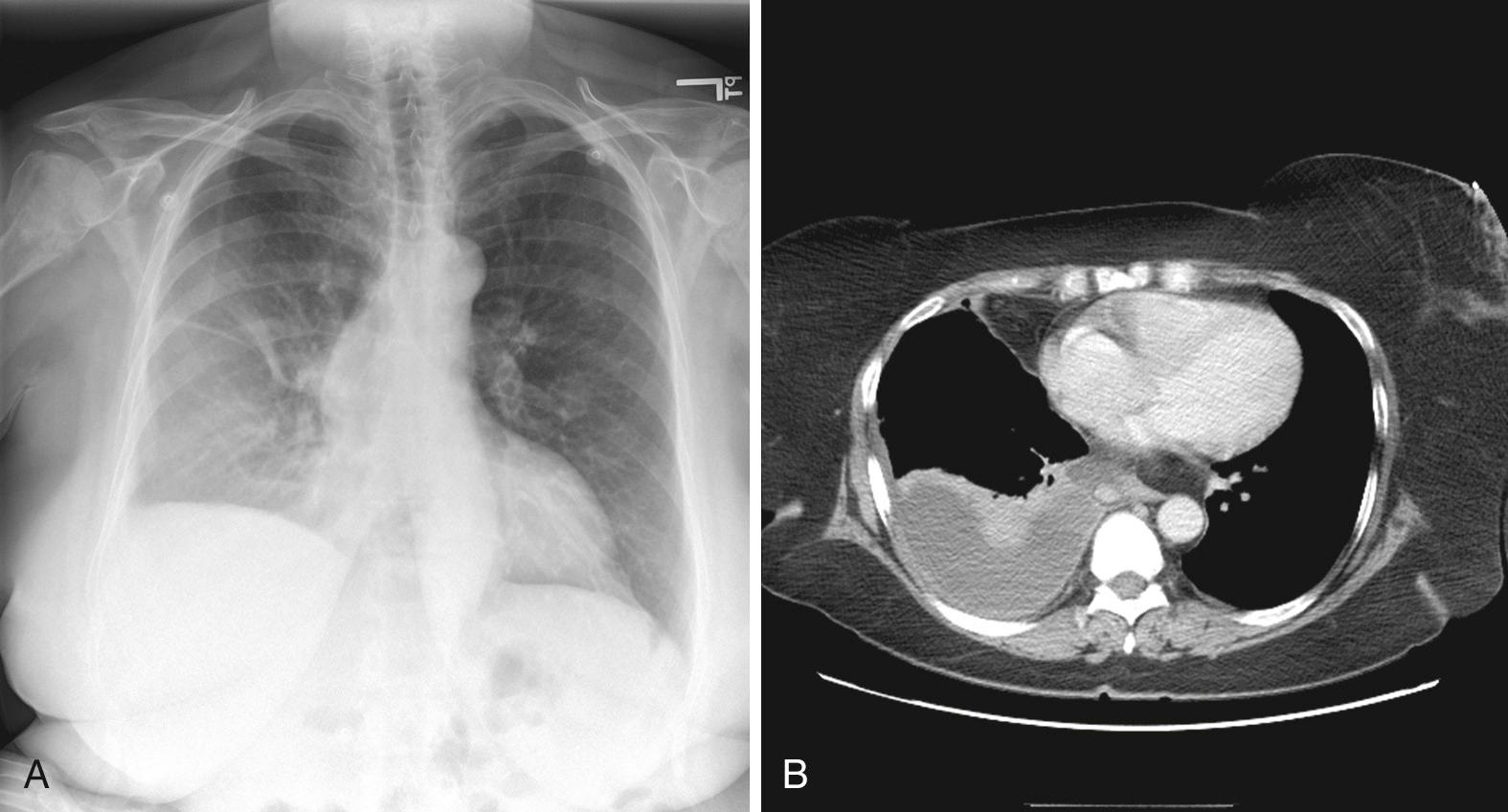 Figure 9.5, A, Supine radiograph of a patient with a large pleural effusion. Note the generalized homogeneous (“ground glass”) increase in radiopacity of the right side of this patient because of posterior layering of a pleural effusion. Also note the difference in the appearance of the pleural effusion when the patient is supine. As opposed to the upright radiograph (see Fig. 9.3 ), there is minimal blunting of the costophrenic angles and the vascular opacities are preserved in the overlying lung. B, A chest computed tomography (CT) scan of the same patient confirms the presence of a right-sided pleural effusion. Note the typical sickle-shaped appearance of the effusion on CT.
