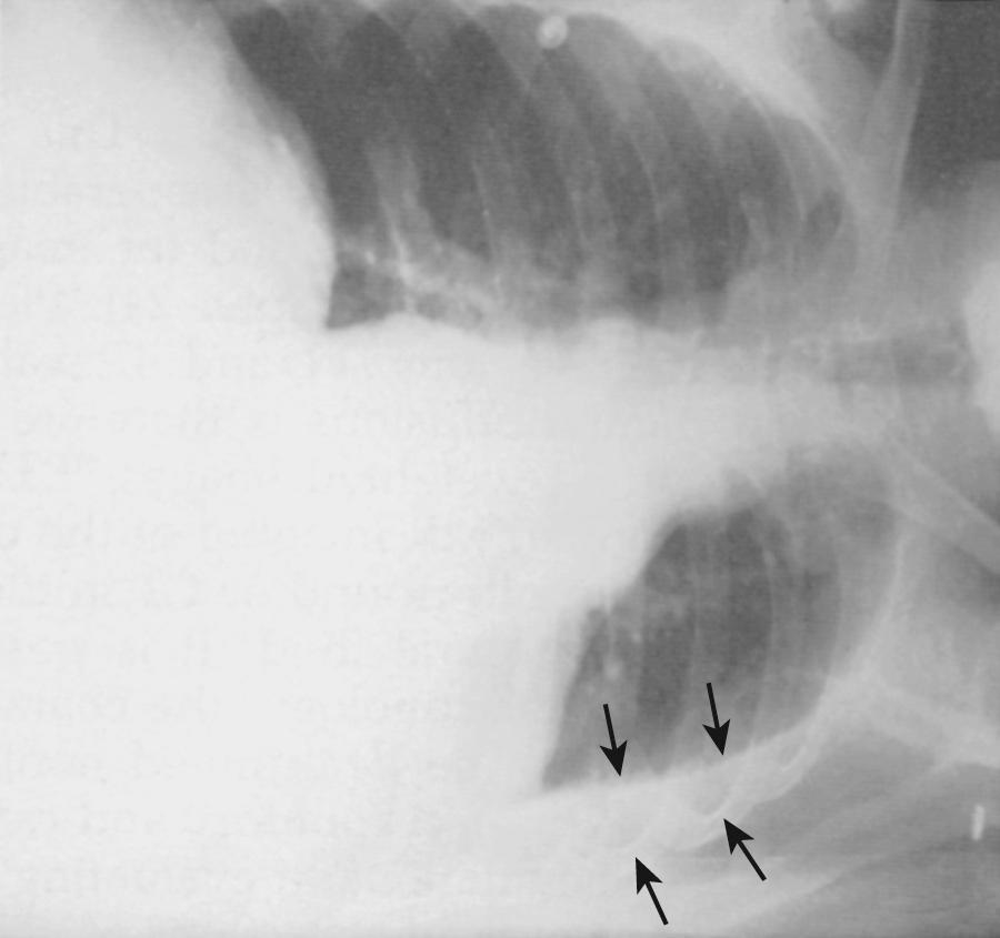 Figure 9.6, Left lateral decubitus chest radiograph demonstrating the presence of free pleural fluid. The amount of pleural fluid can be semiquantified by measuring the distance between the two arrows . Thoracentesis may be difficult to perform if the fluid distance is less than 1 cm on the lateral decubitus radiograph. This view may also differentiate simple effusions from loculated effusions.