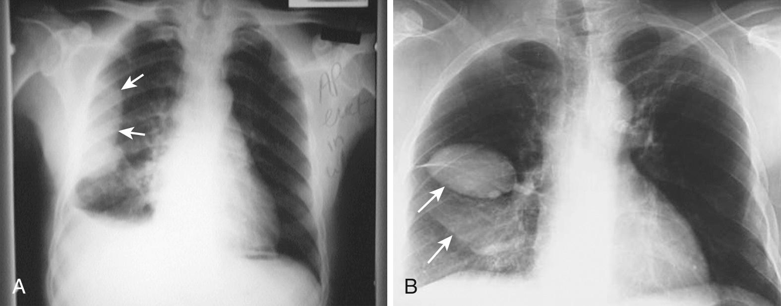 Figure 9.7, Loculated pleural effusion. A, A posteroanterior radiograph demonstrates the D-shaped appearance of a right-sided loculated pleural effusion (arrows) in the midchest region. B, Occasionally, pleural effusions (arrows) may become loculated in the fissures.