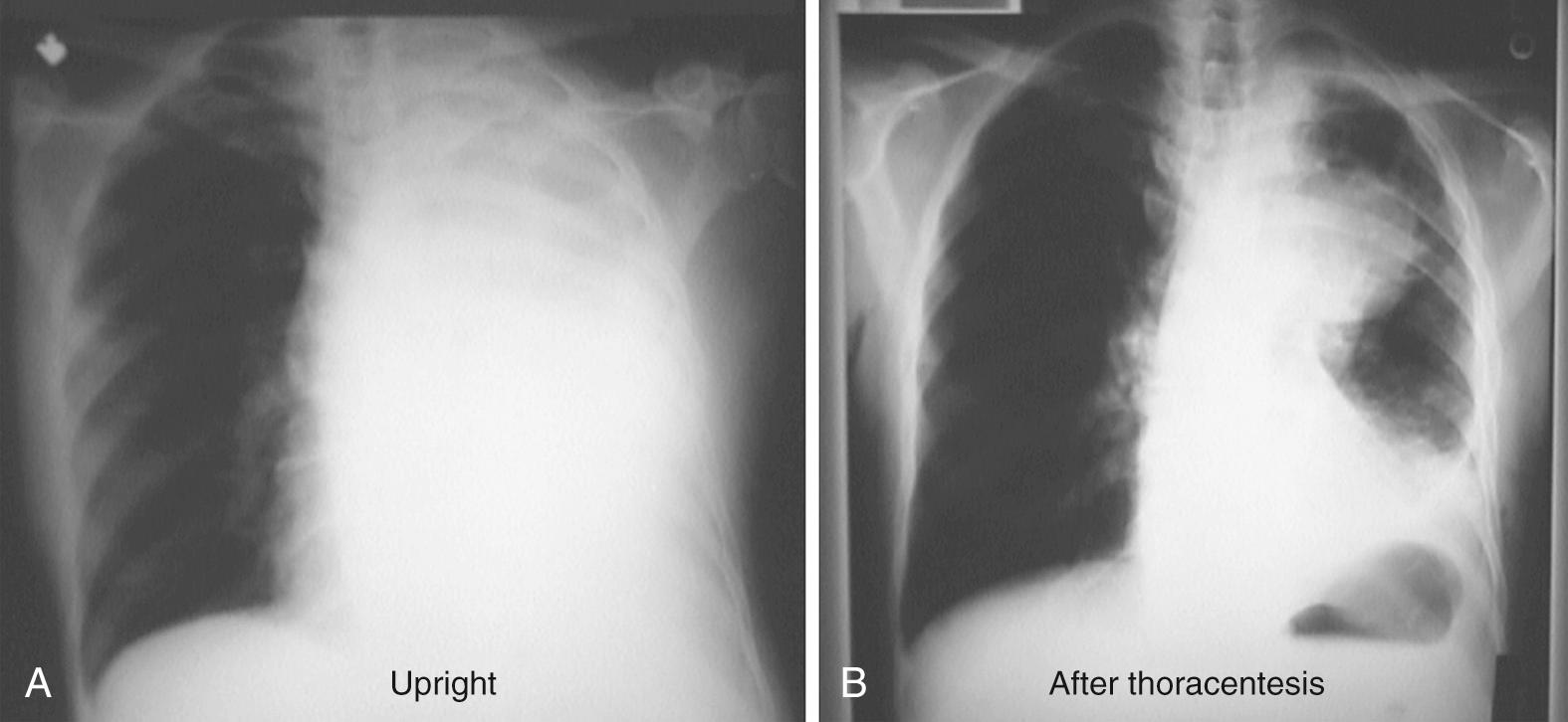 Figure 9.8, Massive pleural effusion A, before and B, after thoracentesis. Notice the underlying mass that is seen following thoracentesis. A computed tomography scan would have prospectively confirmed this radiograph.