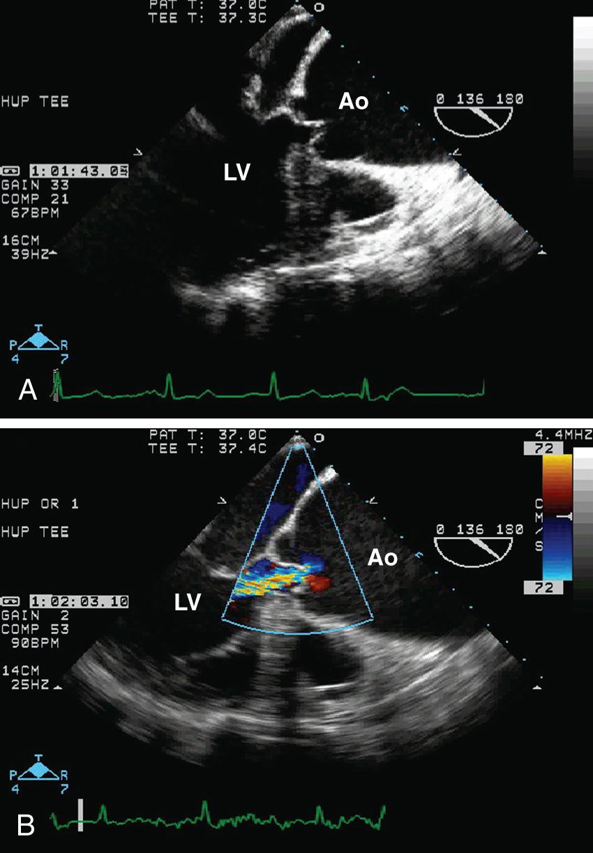 Fig. 17.1, Transesophageal echocardiographic midesophageal long-axis images of the aortic valve demonstrating aneurysmal dilation of the aortic root and ascending aorta (A). Doppler color-flow imaging (B) demonstrating severe aortic regurgitation caused by outward tethering of the aortic valve cusps by the aortic aneurysm. Ao, Aorta; LV, left ventricle.