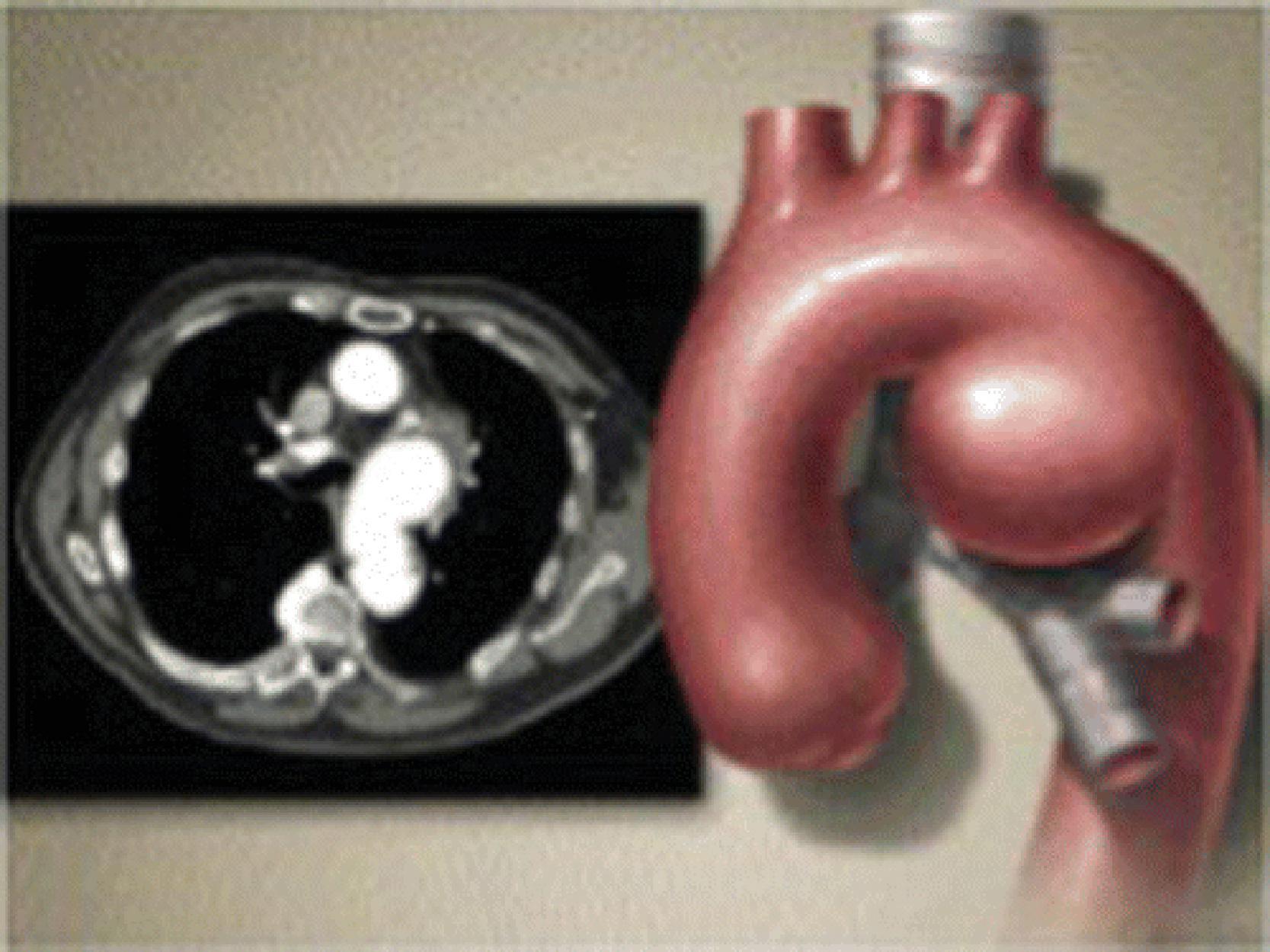 • Fig. 39.2, An artistic rendering of a thoracic aortic aneurysm located superior to the left mainstem bronchus, as well as a computed tomography scan of the same.