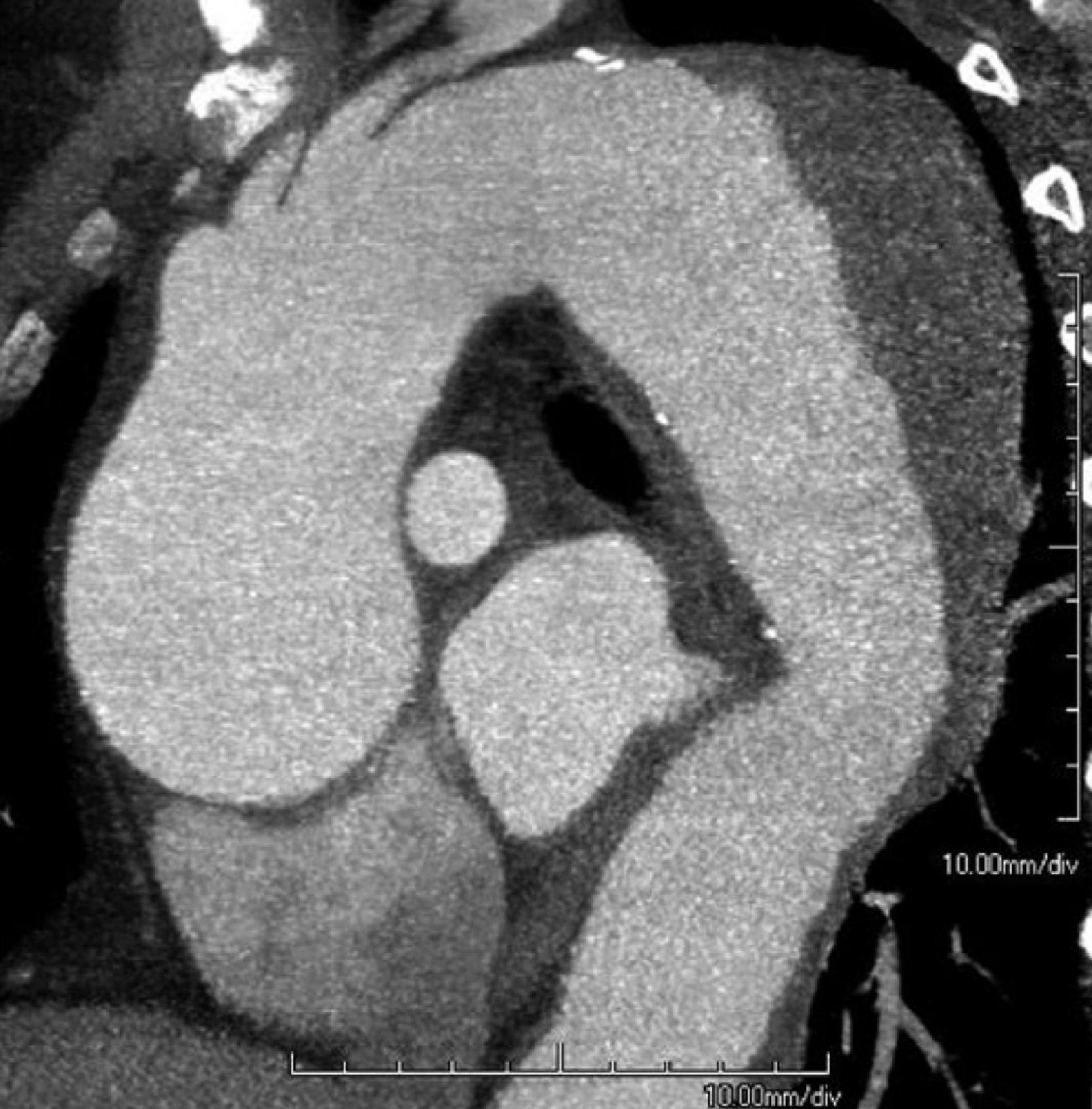 • Fig. 39.3, A computed tomography angiography of a diffusely aneurysmal thoracic aorta in a patient with Marfan syndrome.