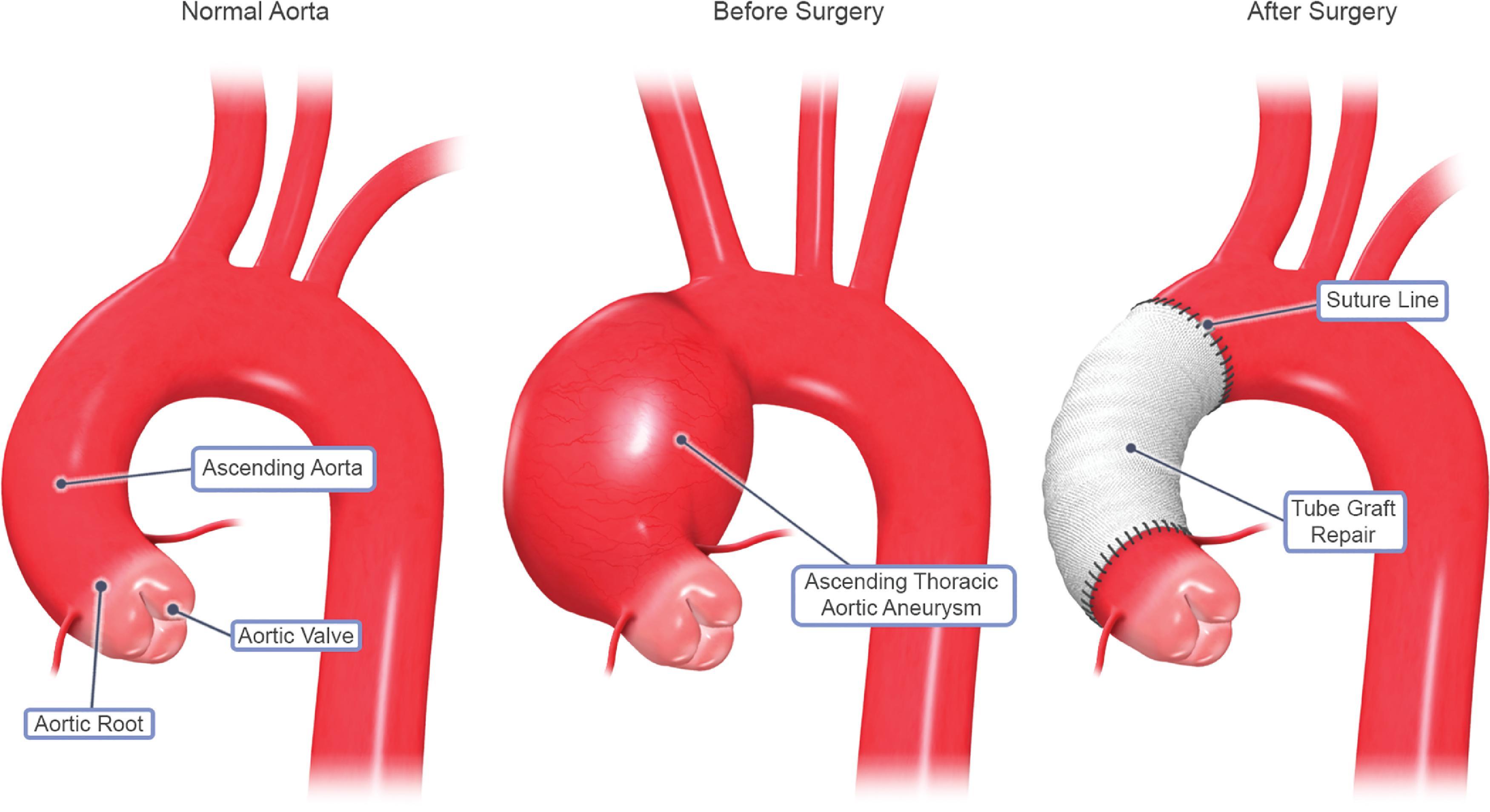 • Fig. 39.4, An example of an ascending thoracic aortic aneurysm repair utilizing a tube graft.