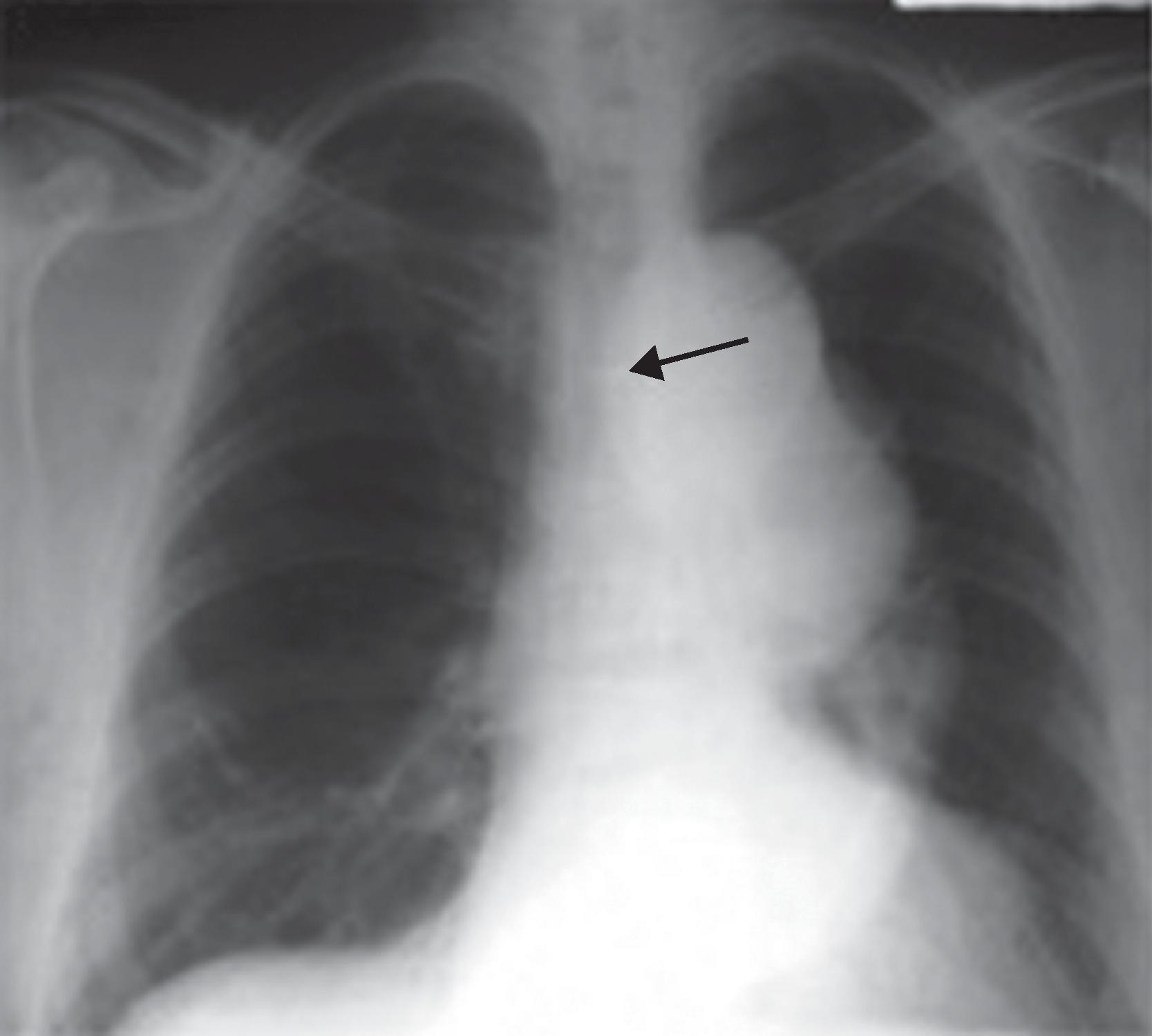 • Fig. 39.5, A preoperative chest x-ray of a thoracic aortic aneurysm compressing the airway.