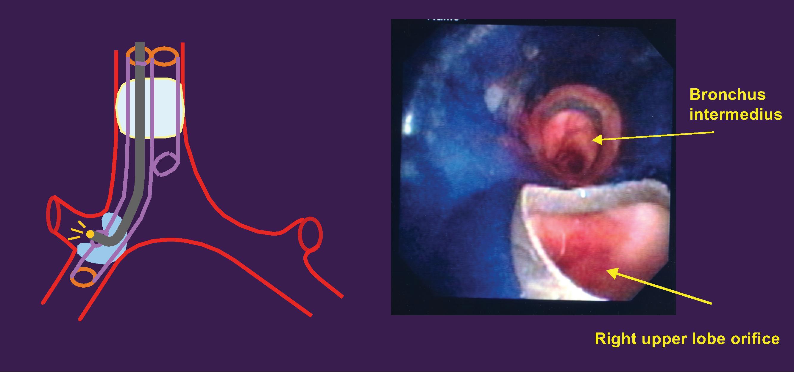 • Fig. 39.6, A bronchoscopy through a right-sided double-lumen tube.