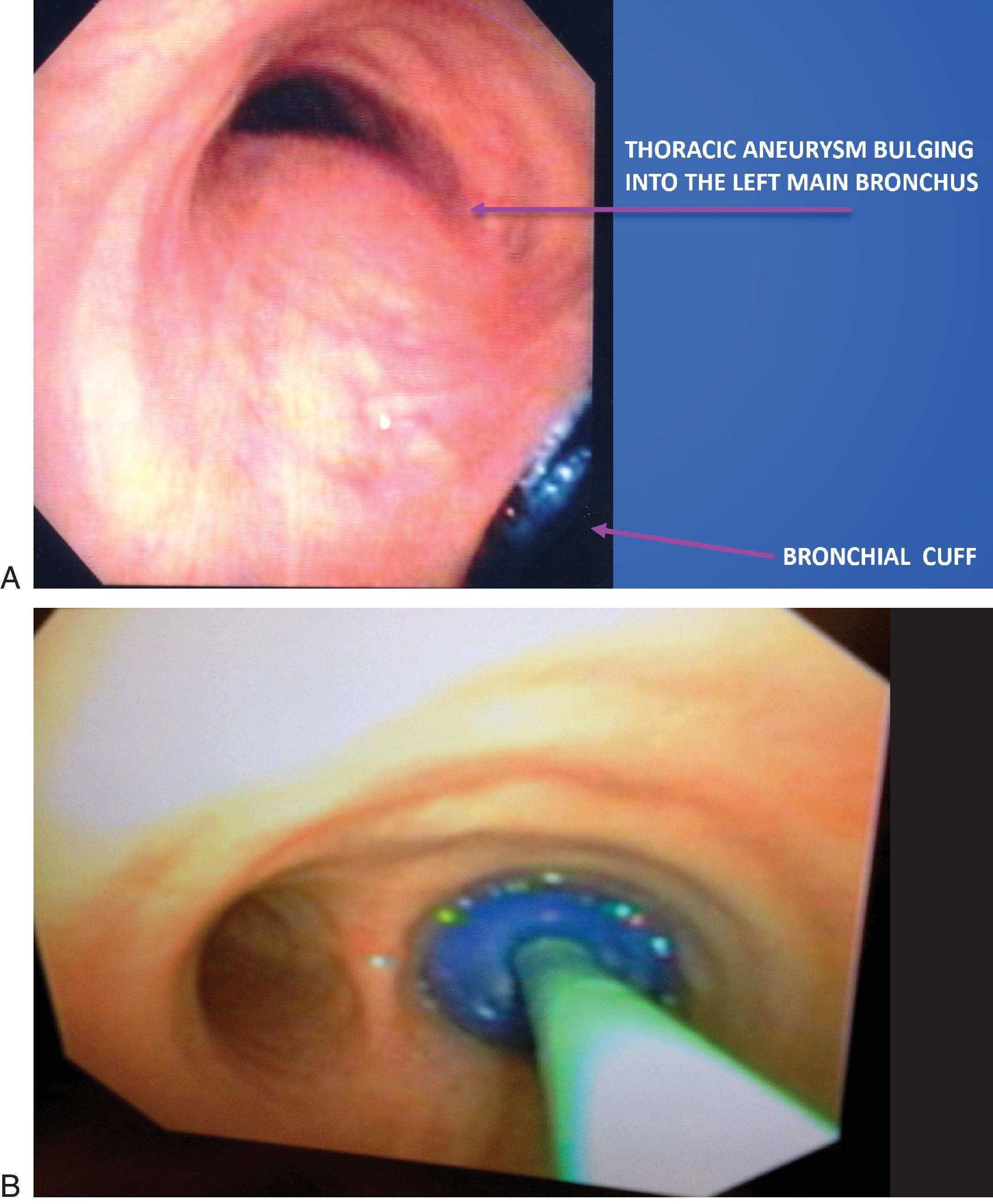 • Fig. 39.7, A. A tracheal bronchoscopy through a double-lumen tube in a patient with a thoracic aortic aneurysm. B. An endobronchial blocker in situ .
