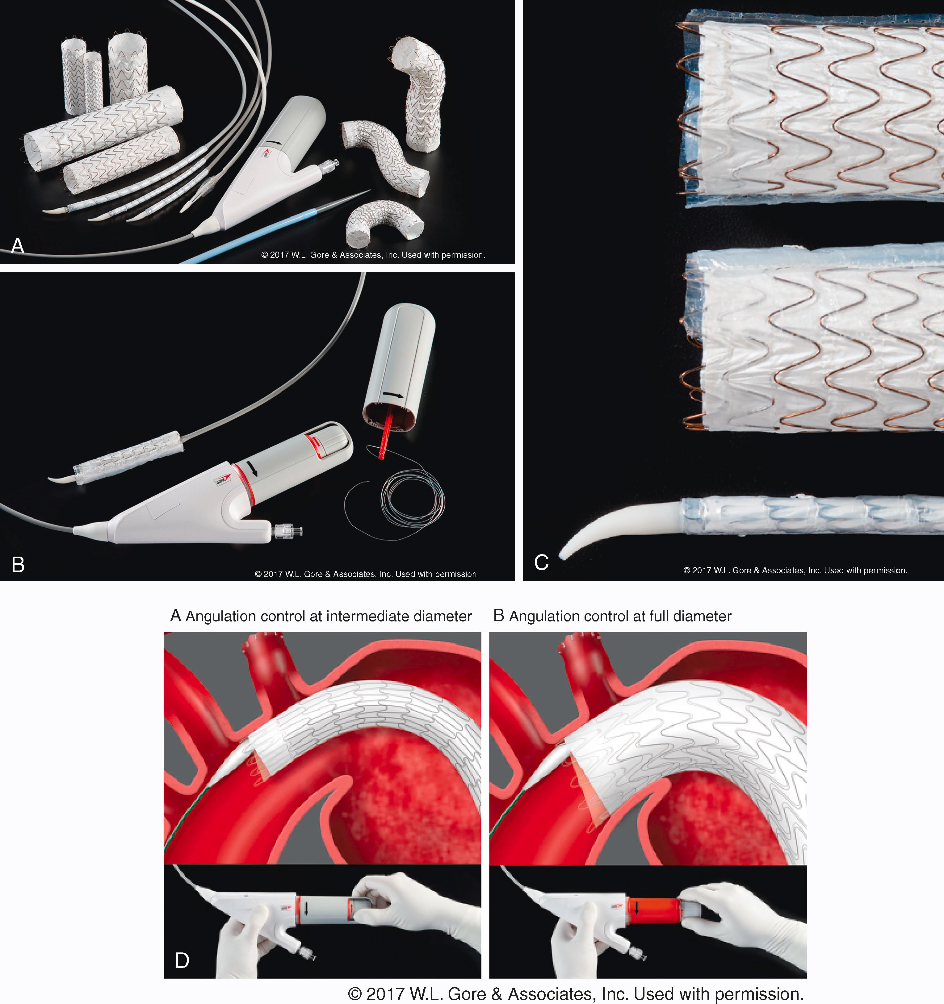 Figure 80.1, ( A ) Gore TAG Conformable Thoracic Stent Graft with Active Control System and accessory devices. ( B ) The nested handle enable stepwise deployment and optional angulation of the endograft. ( C ) The endograft is constrained inside two sleeves. The precurved olive tip is designed to enable self-orientation of the device toward the outer aortic curvature. ( D ) Staged deployment: after primary deployment the first figure shows the device at its intermediate diameter which allows continuous flow through and around the endograft. A second deployment step completely expands the endograft. The optional angulation feature can be used at both stages of deployment.