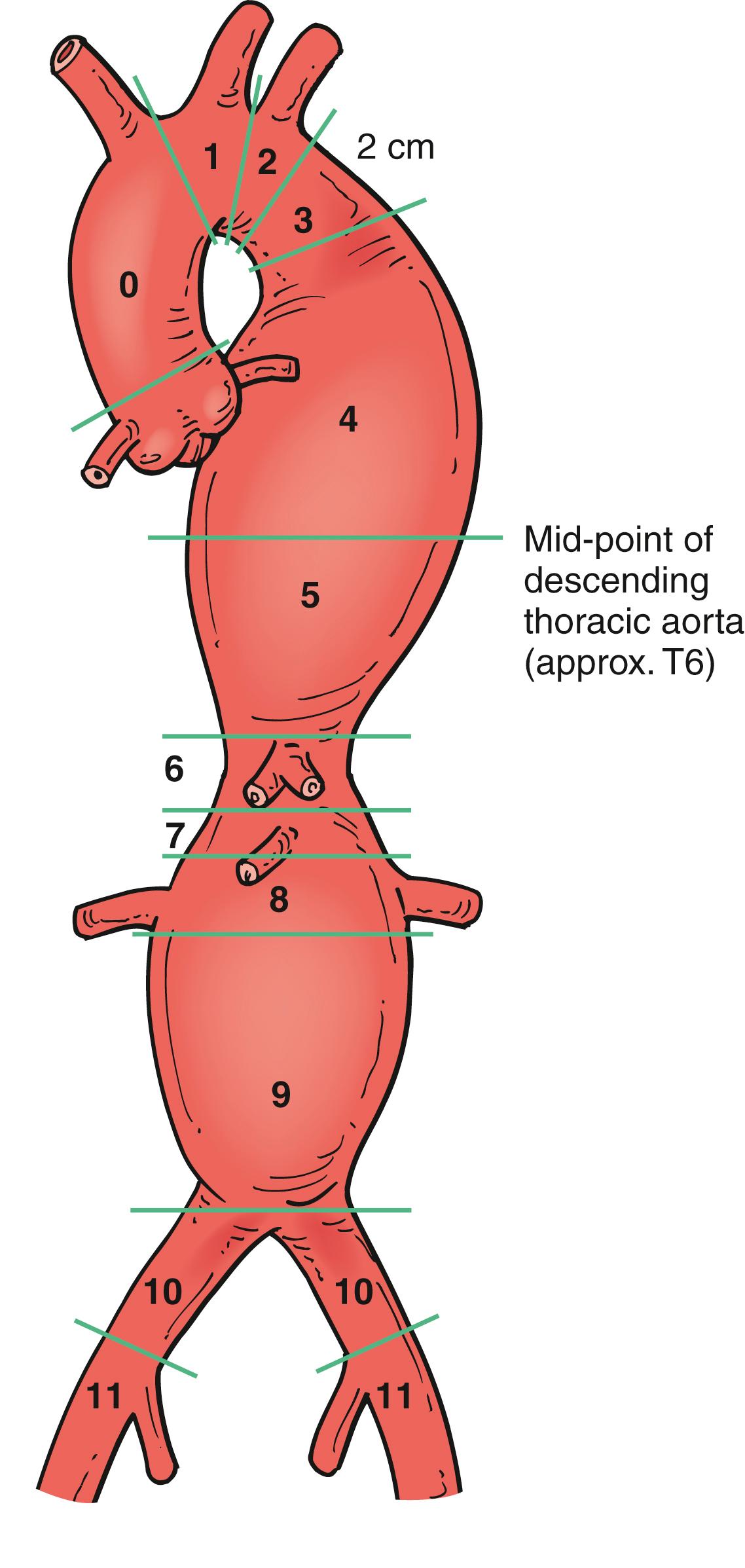Figure 80.6, Eleven landing zones for thoracic aorta interventions.