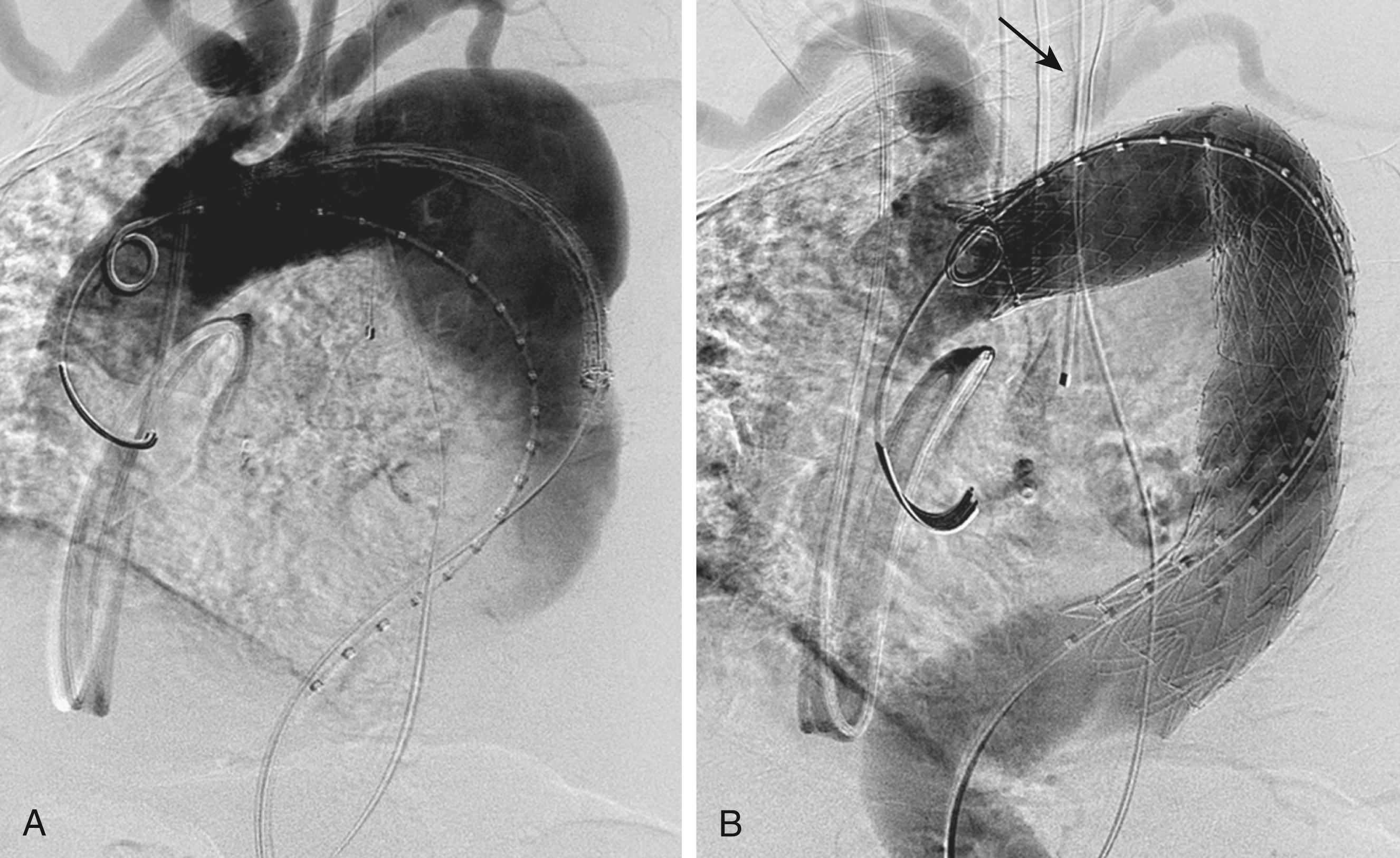 Figure 80.7, ( A ) Operative thoracic aortography demonstrating a large thoracic aortic aneurysm. Note the parallel proximal and distal landing zones. ( B ) Completion aortography showing the thoracic endograft deployed proximal to the left subclavian artery with exclusion of the aneurysm. Note the retrograde filling of the left subclavian artery without endoleak (arrow) .