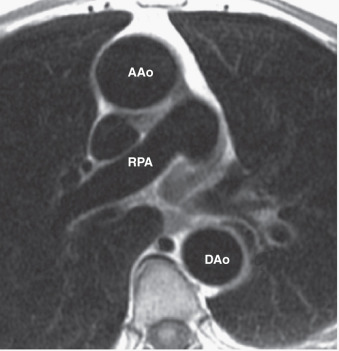 FIG. 43.1, Black-blood vascular imaging of the aorta obtained with cardiac gating and breath holding. Axial image shows the ascending (AAo) and descending (DAo) aorta at the level of the right pulmonary artery (RPA). Note the excellent suppression of the luminal blood signal and demonstration of the vessel wall.