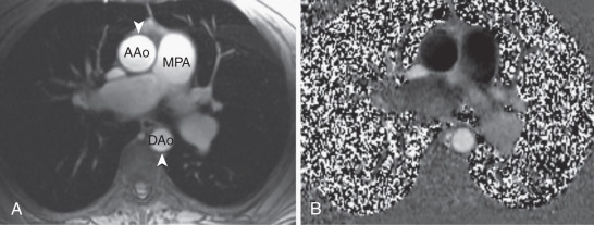 FIG. 43.2, Phase-contrast imaging of the aorta. Magnitude (A) and phase (B) axial images show the ascending (AAo) and descending (DAo) aorta at the level of the main pulmonary artery (MPA). Flow encoding was superior to inferior. On the phase image (B), the ascending aorta and main pulmonary artery appear black, and the descending aorta appears white, owing to the opposite directions of flow in these arteries.