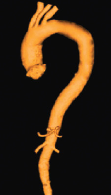 FIG. 43.3, Gadolinium-enhanced three-dimensional magnetic resonance angiography of the thoracic aorta (surface-shaded display algorithm).