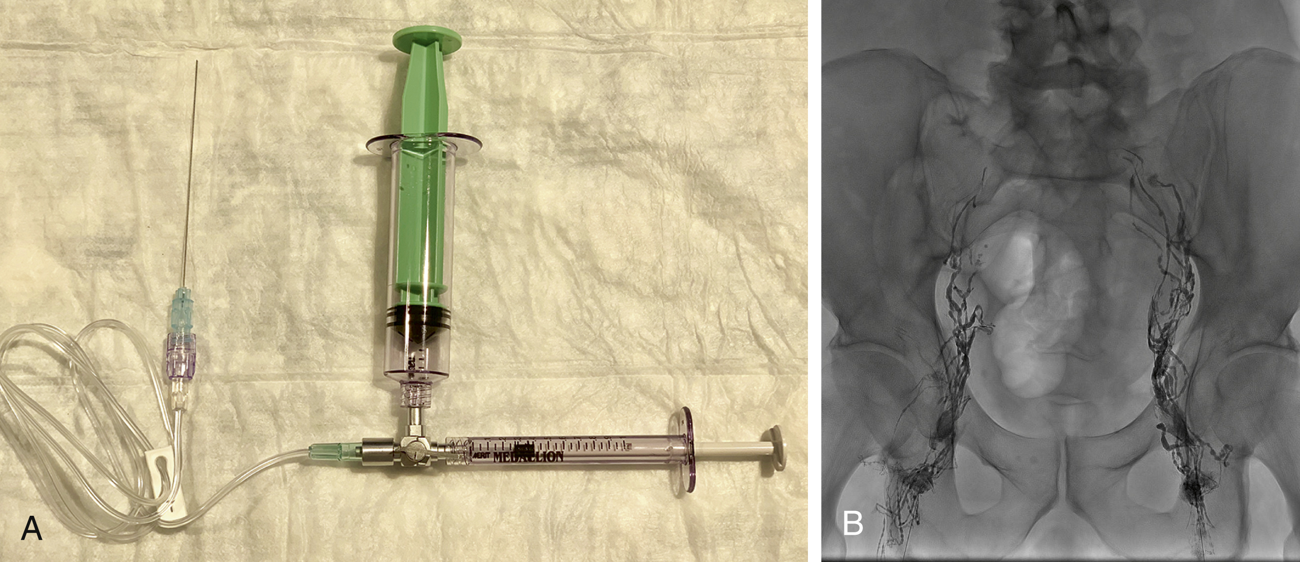 Fig. 86.1, Intranodal lymphangiography. The equipment utilized for intranodal lymphangiography (A) and successful bilateral inguinal lymphangiography (B) is shown.