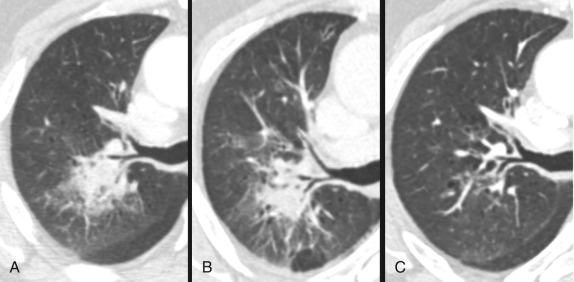 Figure 42.1, (A) Axial contrast-enhanced CT images show a consolidative right upper lobe opacity abutting the major fissure, surrounded by ground-glass opacity. (B) Three weeks later, the lesion has decreased in size, and bronchoscopy yielded Pneumococcus. (C) With treatment, the infection completely resolved at 3 months.