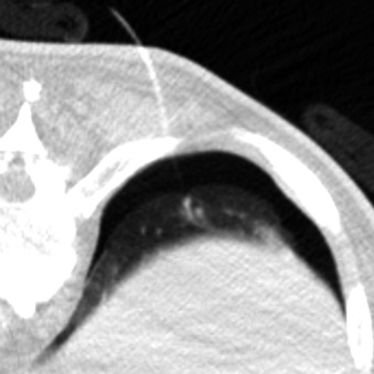 Figure 42.11, Axial noncontrast enhanced CT image shows a 5-Fr catheter used to aspirate a small left pneumothorax during a lung biopsy (introducer needle not shown).