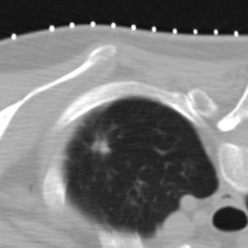 Figure 42.3, Axial noncontrast CT image shows the biopsy target, a left apical nodule. The patient is prone and the biopsy grid lies on the skin of the upper back. Note that a rib blocks the path from the skin to the target.